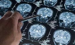 Alzheimer araştırmalarında riski artıran genetik varyant bulundu