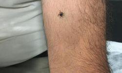 Kene vakalarında doğru bilinen çok fazla yanlış var!