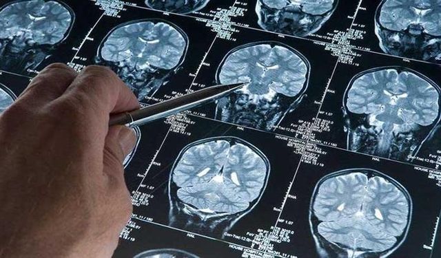 Alzheimer araştırmalarında riski artıran genetik varyant bulundu